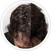 Dandruff