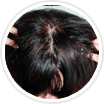 Dandruff